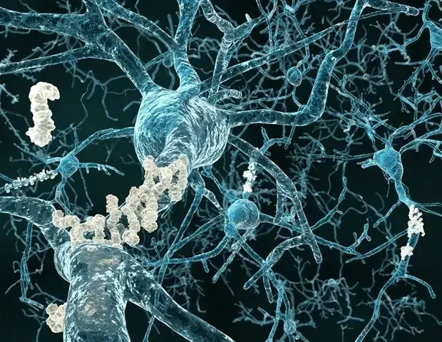 Alzheimer's Drug Trials Mask Patient Variability