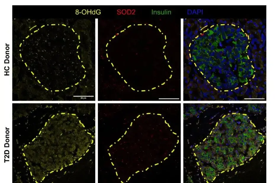 Beta Cells Take Center Stage in New Type 1 Diabetes Research
