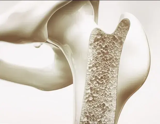Breakthrough in Bone Repair with Mineralized DNA Hydrogel