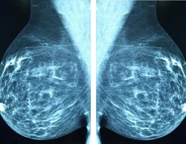 Breast Cancer Risk Missed