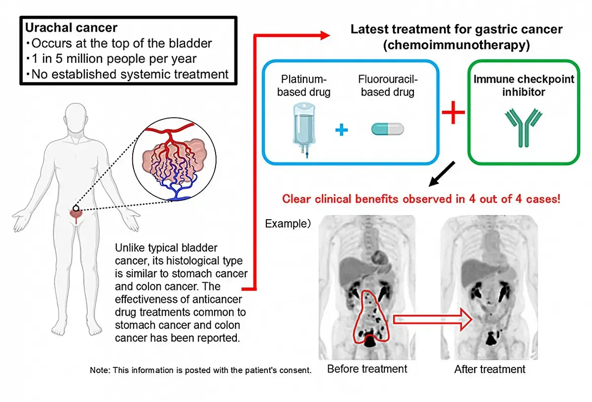 Chemoimmunotherapy Shows Promise for Ultra-Rare Urachal Cancer