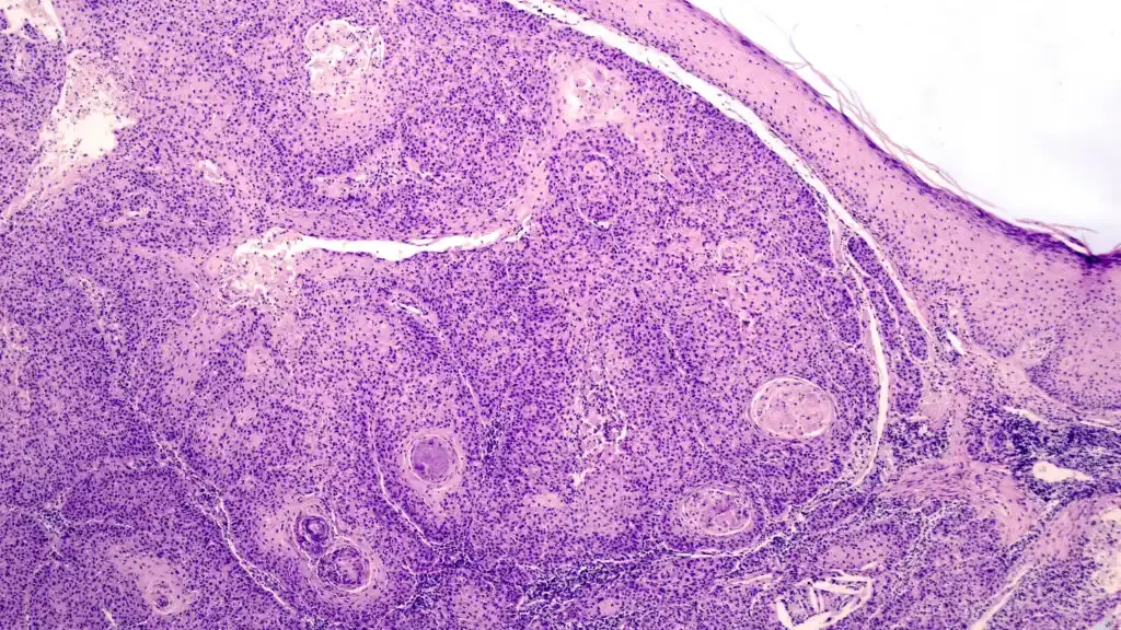 FDA Experts Scrutinize New Melanoma Therapy