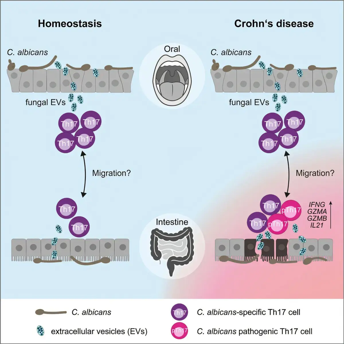 Immune Response to Harmless Yeast Linked to Crohn's Disease