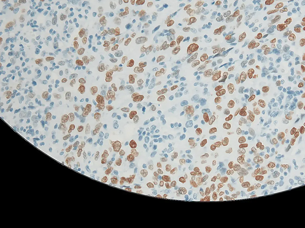 Inherited BRCA2 Changes Linked to Multiple Lung Cancers