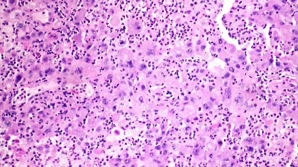 Merck's Lung Cancer Treatment Shows Significant Progress