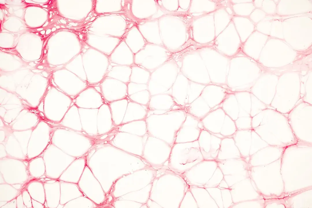 Microvascular Dysfunction Fuels Heart Disease