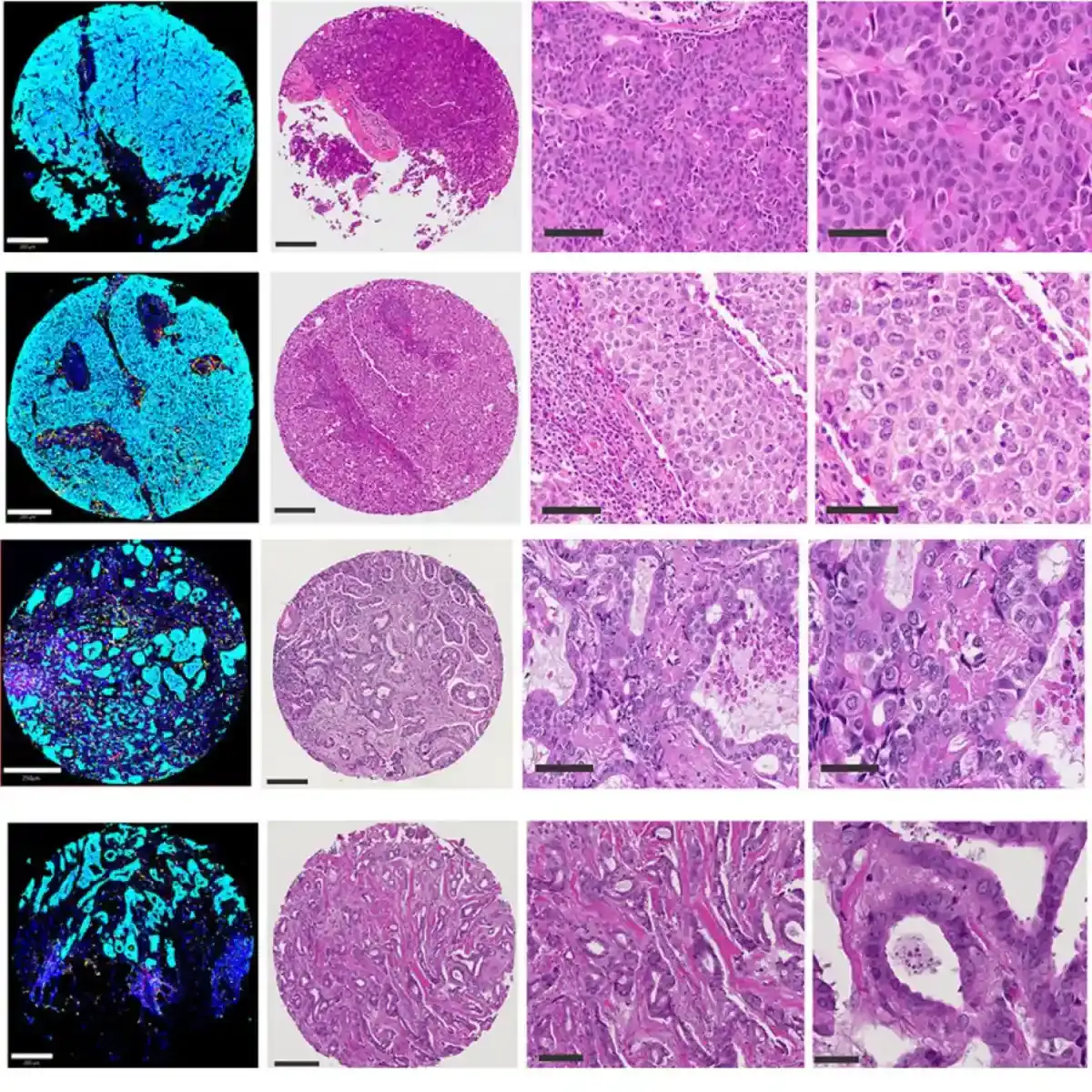 New Breast Cancer Prediction Method