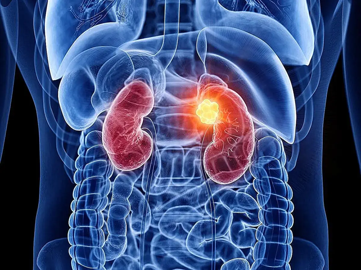 New Combination Therapy Shows Promise for Advanced Kidney Cancer Patients