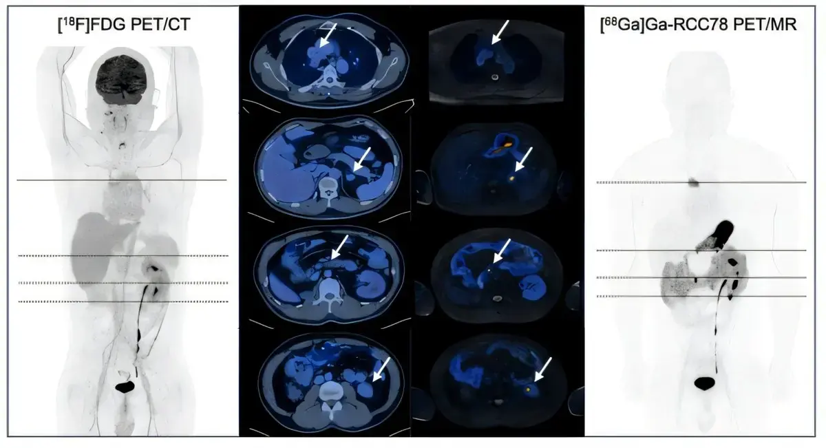 Rapid Detection of Kidney Cancer with New PET Tracer