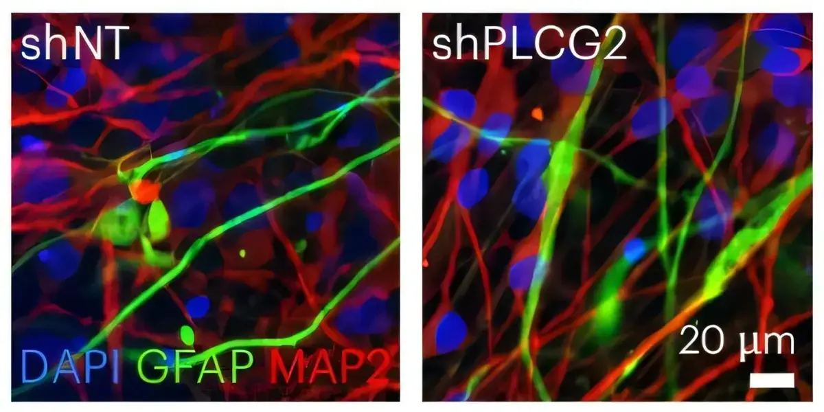 Rare Gene Variants May Significantly Increase Alzheimer's Disease Risk