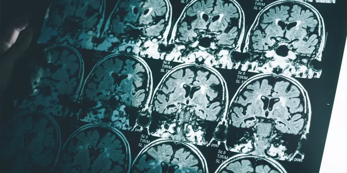 Study Finds Psychopathic Traits Linked to Thinner Cerebral Cortex in Men