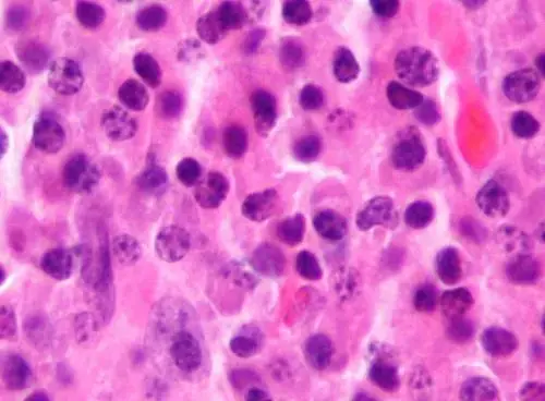 Teclistamab Extends Remission in Relapsed Myeloma