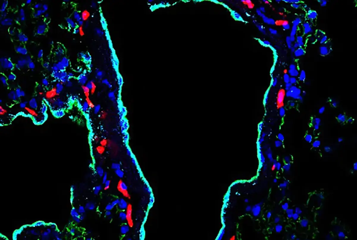 Tumor Protein Creates Leaky Blood Vessels, Boosting Cancer Spread