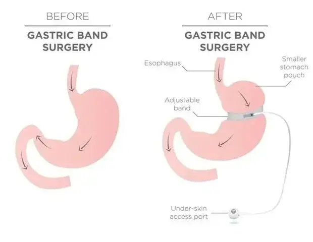 Weight Loss Drug Shows Promise After Bariatric Surgery