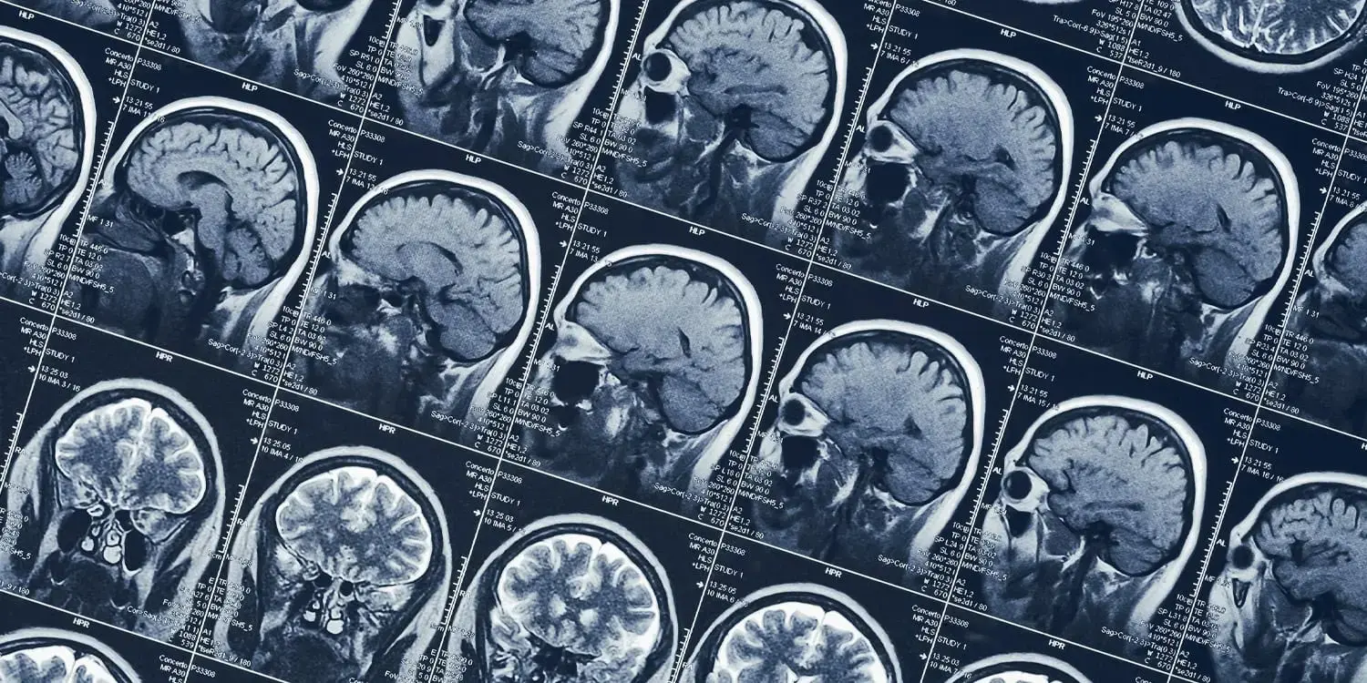 More time spent playing video games is linked to a thinner cerebral cortex in adolescents
