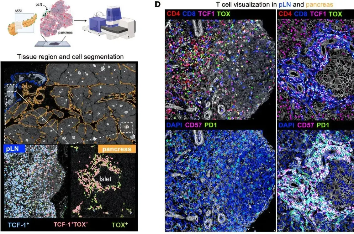 New immune cell clusters identified in type 1 diabetes research