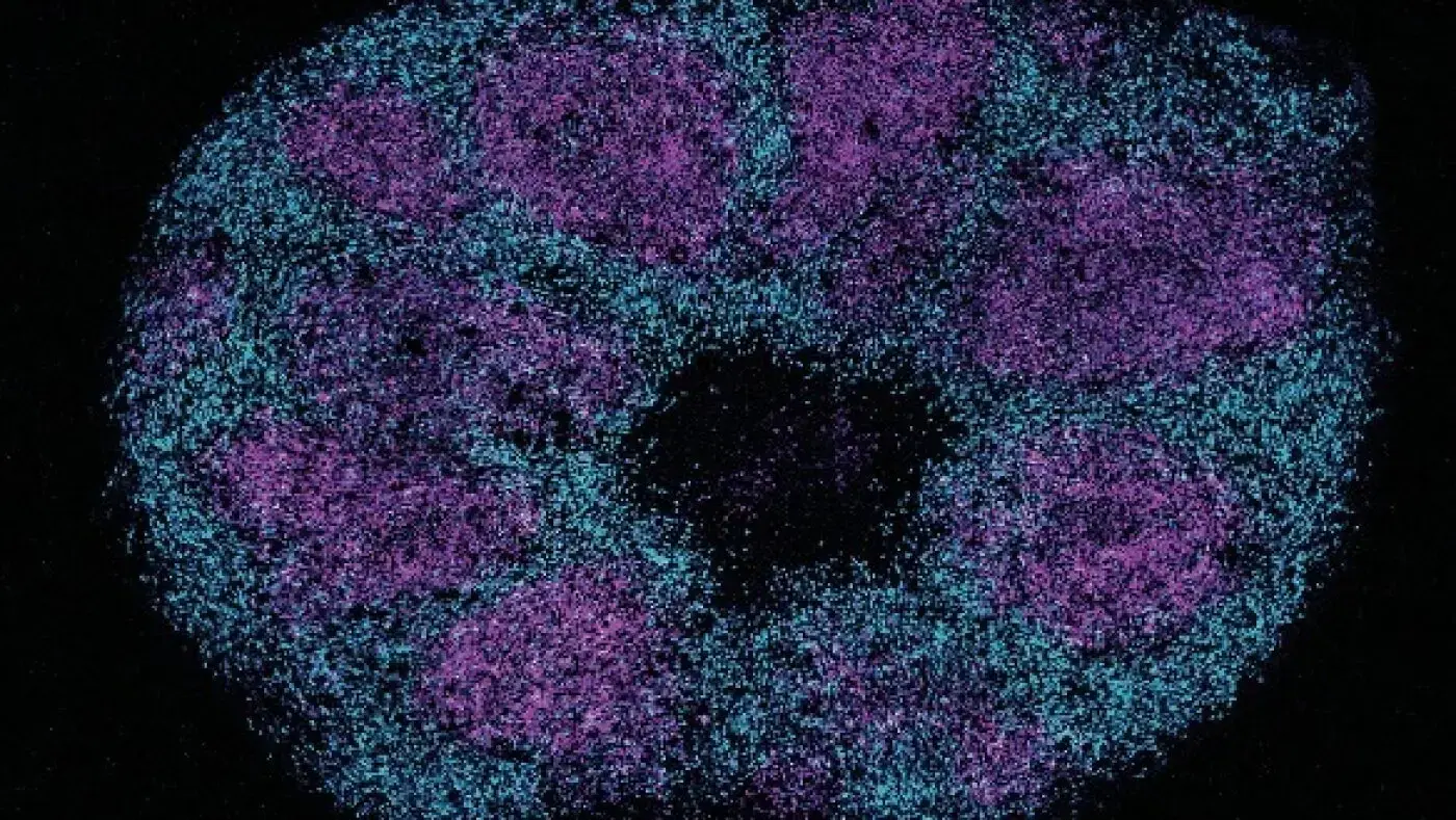 New Protein Map Reveals Hidden Links to Severe Autism