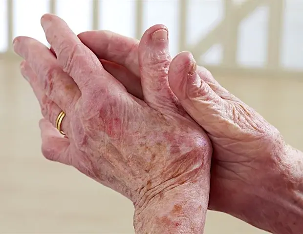 Cannabis Therapy Shows Long‑Term Benefits for Inflammatory Arthritis Patients