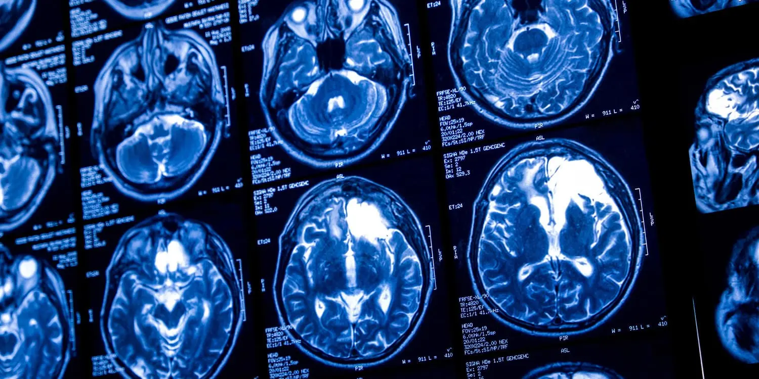 Early cognitive ability predicts adolescent brain development speed