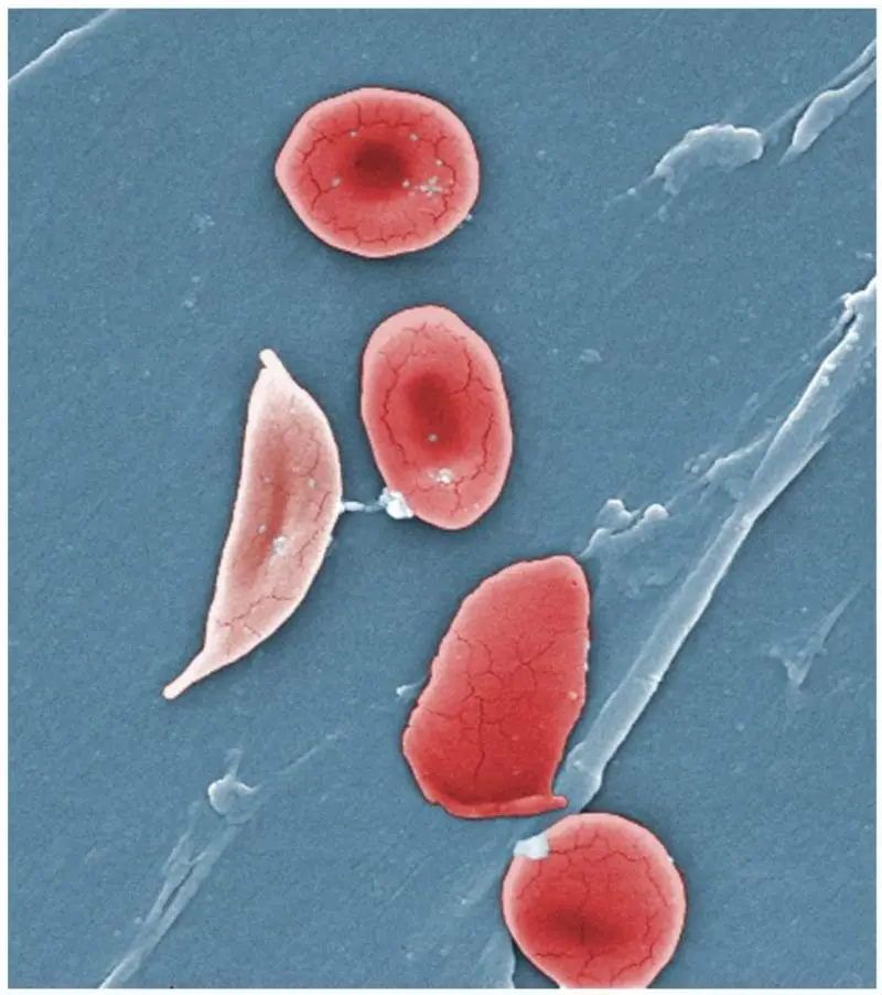 Sickle‑Cell Pain Reveals Unexpected Blood Protein Signatures